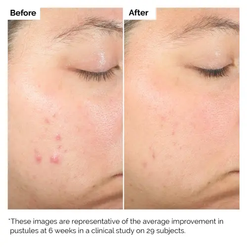 The Ordinary Salicylic Acid 2% Solution 30 mL (1 oz)'s photo #3