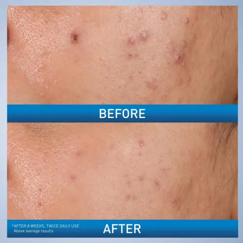 CeraVe Acne Control Gel 2% Salicylic Acid Acne Treatment 40 mL (1.35 oz)'s photo #5