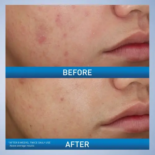 CeraVe Acne Foaming Cream Wash 10% Benzoyl Peroxide Acne Treatment Maximum Strength 150 mL (5 oz)'s photo #5