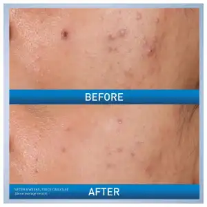 CeraVe Acne Control Gel 2% Salicylic Acid Acne Treatment 40 mL (1.35 oz) miniatura 6