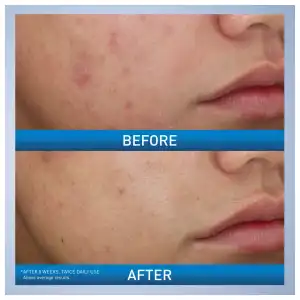CeraVe Acne Foaming Cream Wash 10% Benzoyl Peroxide Acne Treatment Maximum Strength 150 mL (5 oz) miniatura 6
