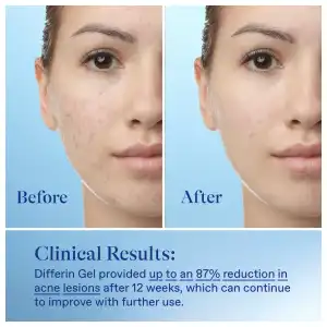 Differin Gel Adapalene Gel 0.1% Acne Treatment 15 g (0.5 oz) miniatura 5